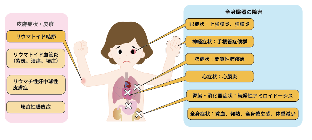 リウマチ性心疾患とは何ですか?